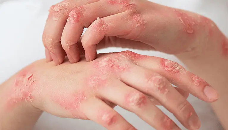 Dermatitis | Atopijski u odnosu na kontaktni